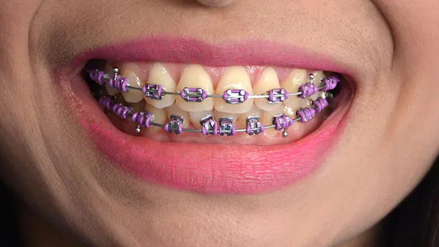 Close de um sorriso com aparelho fixo tradicional de braquetes metálicos e fio