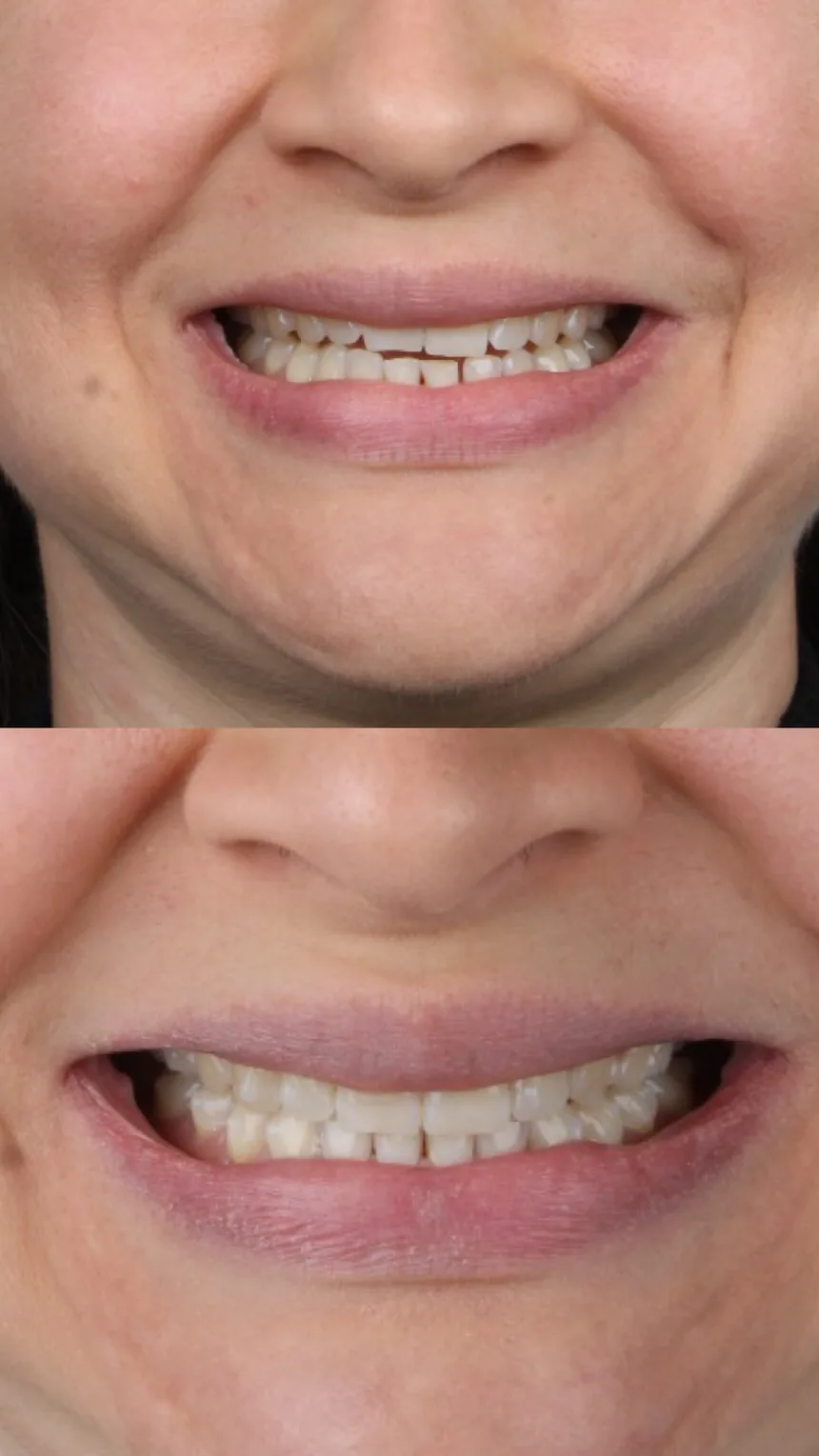 Antes e depois de tratamento ortodôntico com a Dra. Juliana Braga, caso 1