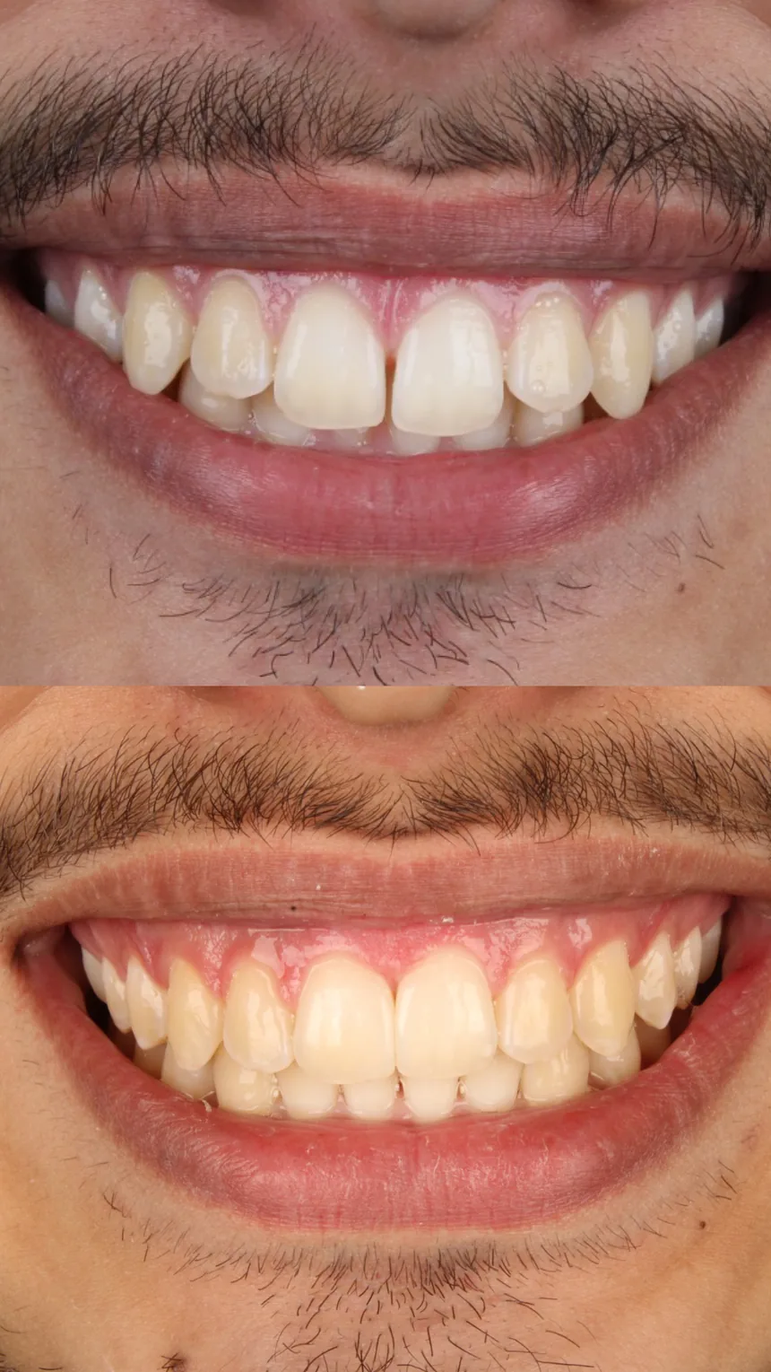 Antes e depois de tratamento ortodôntico com a Dra. Juliana Braga, caso 2