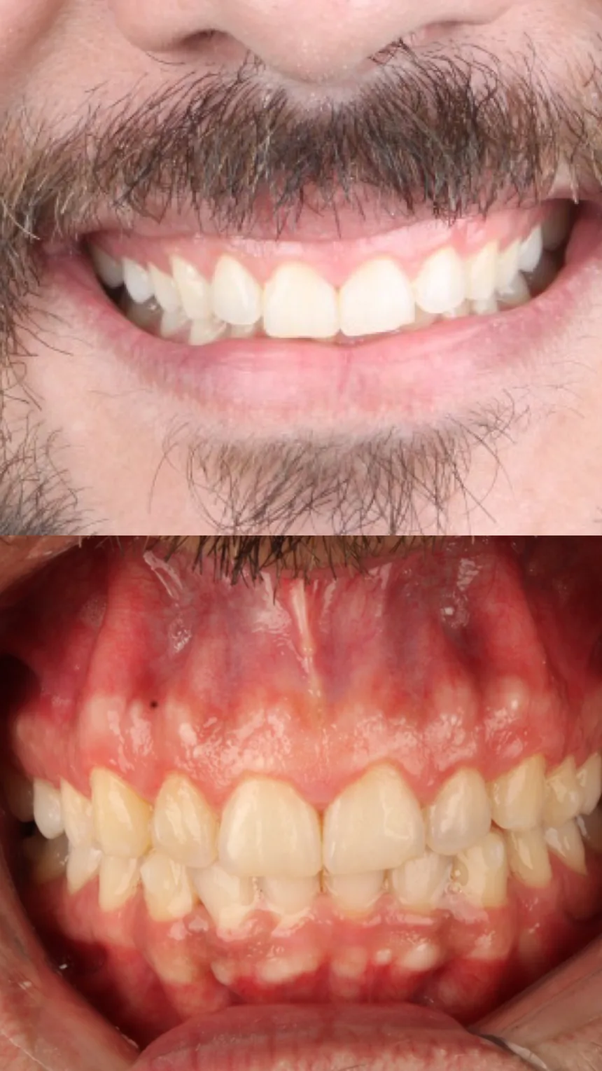Antes e depois de tratamento ortodôntico com a Dra. Juliana Braga, caso 3